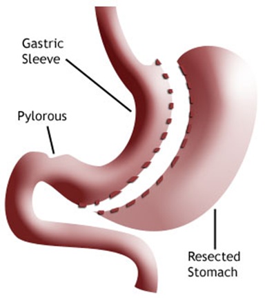 sleeve gastrectomy